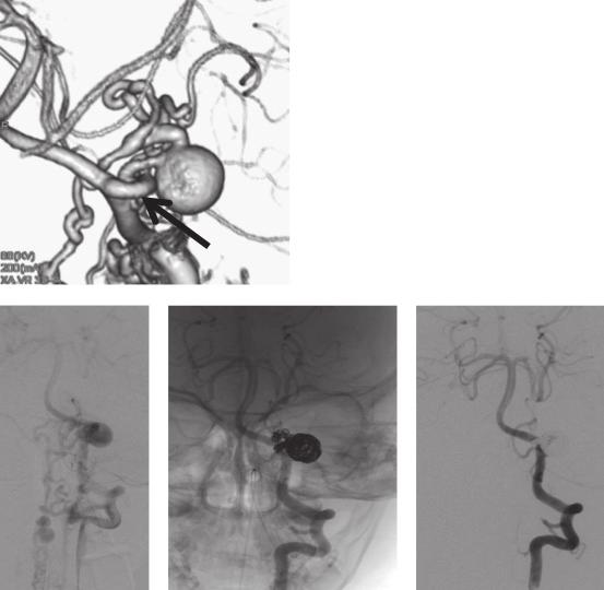Pial AVF in a child with hemiplegia K. Hatayama et al. (A) (B) (C) (D) Figure 3. Spinal DSA imaging. (A) Spinal 3D-DSA shows a varix on the PICA and shunt from the varix to the spinal vein.