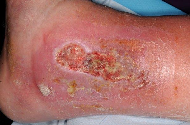 prevent effectiveness of topical treatments may cause underestimation of the