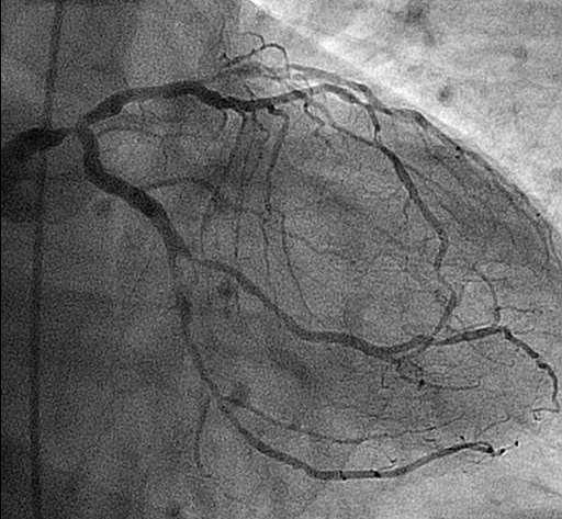 Left Main Coronary Artery Disease Distal location