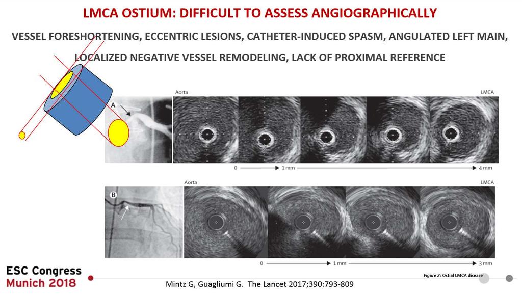 IVUS for LM