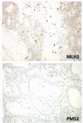 PD-1 Blockade in non-crc MMR Deficient Cancer Mismatch repair deficiency refers to