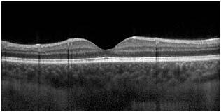 Choroidal Thickness After