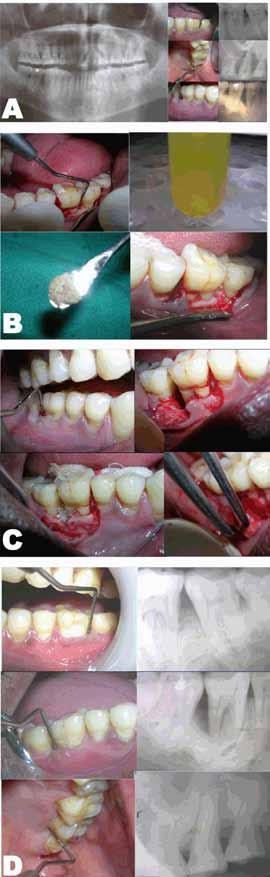 Singh et al. 469 examination, there were deep pockets > 5 mm in 46, 36 and 27. There was bleeding on probing in all the three teeth involved.