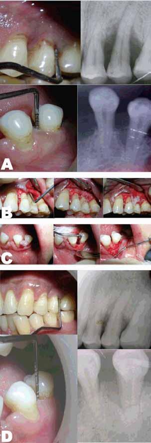 Singh et al. 470 Case 4: A 17-year-old female reported with the chief complaint of pus discharge and mobility in relation to lower anterior tooth since two months.