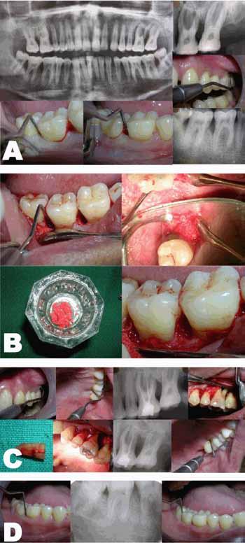 Singh et al. 471 Figure 4: Case 4 tooth #31. Figure 3: (A) Preoperative clinical evaluation and OPG. (B) Tooth #46, 47 treated using autogenous graft.
