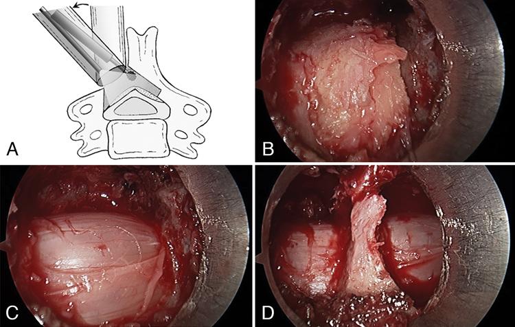 Microendoscopic laminotomy for CSM FIG. 1. CMEL is performed for CSM. A: The decompression surgery is performed using a high-speed air drill.