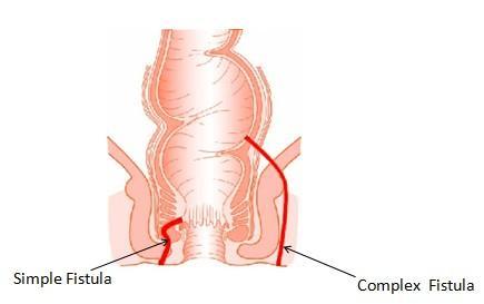 The ideal treatment for anorectal fistula should aim towards low recurrence, early recovery and minimal incontinence.