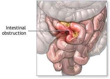 Intestinal obstruction, Ileus (focus on