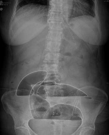 Distended bowel loop > 3cm