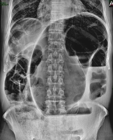 inverted-u shape highly distended bowel loop white line to pelvis Large air-fluid level Sigmoid volvulus: highly