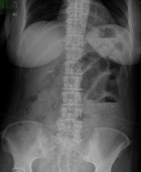 Quiz M55yo after surgery with acute abdomen What s the diagnosis? A. Small bowel (jejunum) obstruction B.