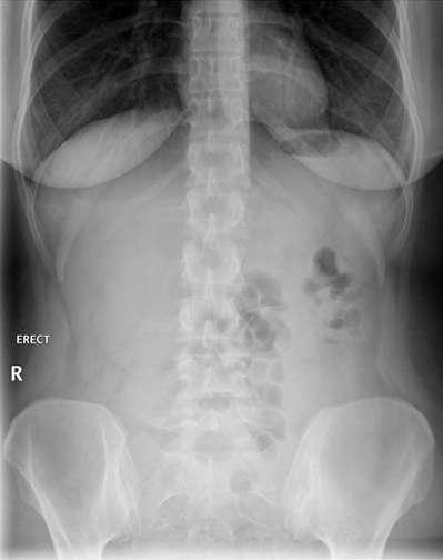 Plain film & normal anatomy The erect abdominal plain film Cover the bilateral diphragm To look for Soft tissue Gas pattern Fat
