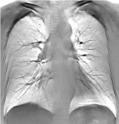 Suchato C Figure 1B: DT reveals subtle pulmonary nodule 4 mm in diameter at left lower lobe. Figure 1C: CT image reveals small pulmonary nodule identical to DT finding.