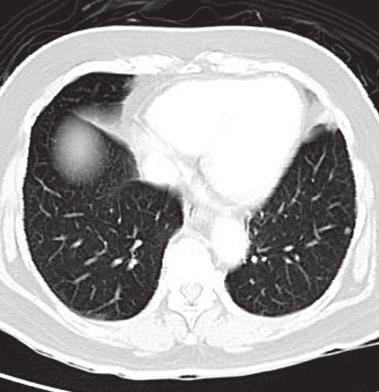 The high resolution CT image shows a subtle parenchymal pulmonary nodule with a spicular appearance at the right middle lung field.