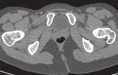 Case Report #4 A 34-year-old Thai male presented with pelvic pain after a car accident. CT image reveals a small piece fracture at the right pubic ramus (Figure 4B-C).