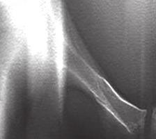 The skeletal digital Figure 3: DT at right sternoclavicular joint reveals definite evidence of linear fracture at the cartilage of the right 1 st rib.