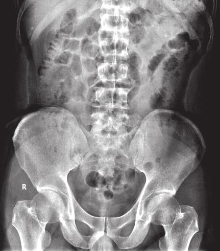 Suchato C Digital Tomosynthesis in the Urologic System Case Report #5 A 60-year-old Thai male presented with sudden abdominal pain, the KUB radiograph reveal a suspected small opaque left renal stone