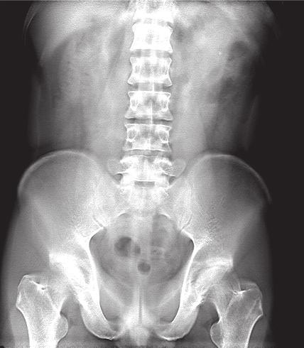 The diagnosis of urolithiasis is normally confirmed by conventional radiography but recently unenhanced CT images have been found to be superior in the precise identification of the stone as well as
