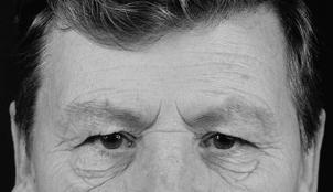 Figure 9-3. (A) The classic torpid facies of severe myxedema in a man. The face appears puffy, and the eyelids are edematous. The skin is thickened and dry.