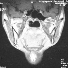 MRI can often demonstrate perineural thickening of the mandibular nerve before osseous changes in the foramen ovale are detectable [7]. At this stage, the patient may remain asymptomatic.