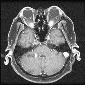 S5 Figure 4 Metastatic disease to the petrous apex and involvement of Meckel s cave in a patient with cranial nerves V3 and VI palsy.