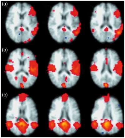 Resting state functional connectivity - fmri Language network Auditory network Default Mode Network = mainly: Posterior cingulate cortex Medial prefrontal cortex Medial