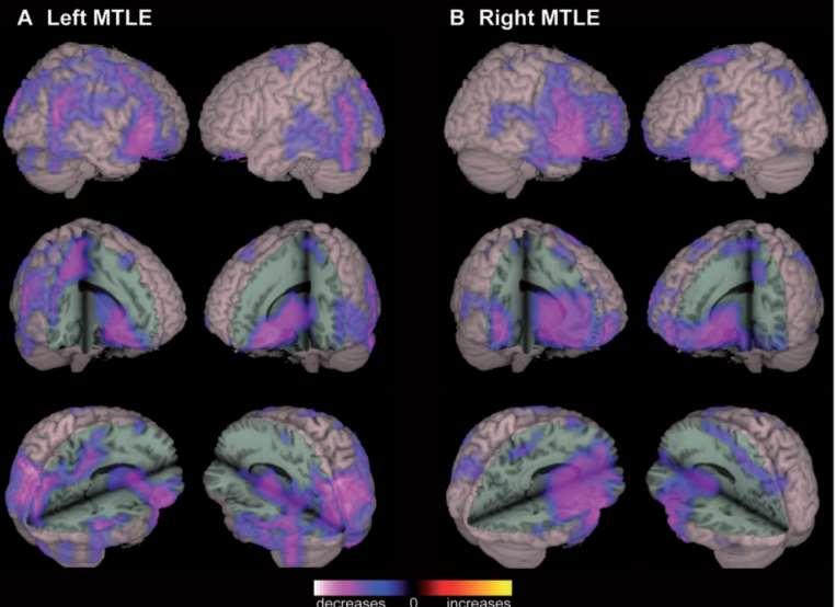 Functional connectivity analysis in epilepsy Englot et al.