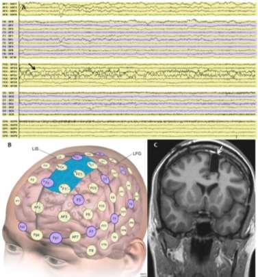 High-resolution EEG with up to 256 surface electrodes 14 Patients with FLE, 7 resective surgery 76 channel surface EEG vs.