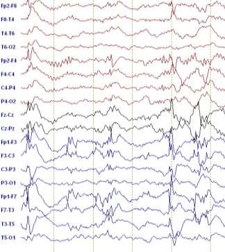 What is EEG source analysis?