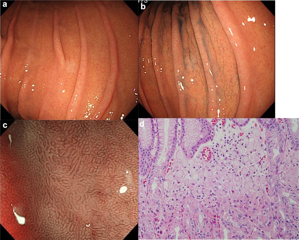Diagnostic accuracy of demarcation using magnifying endoscopy with narrow-band imaging for 989 Helicobacter pylori (H. pylori) is a major cause of inflammation.