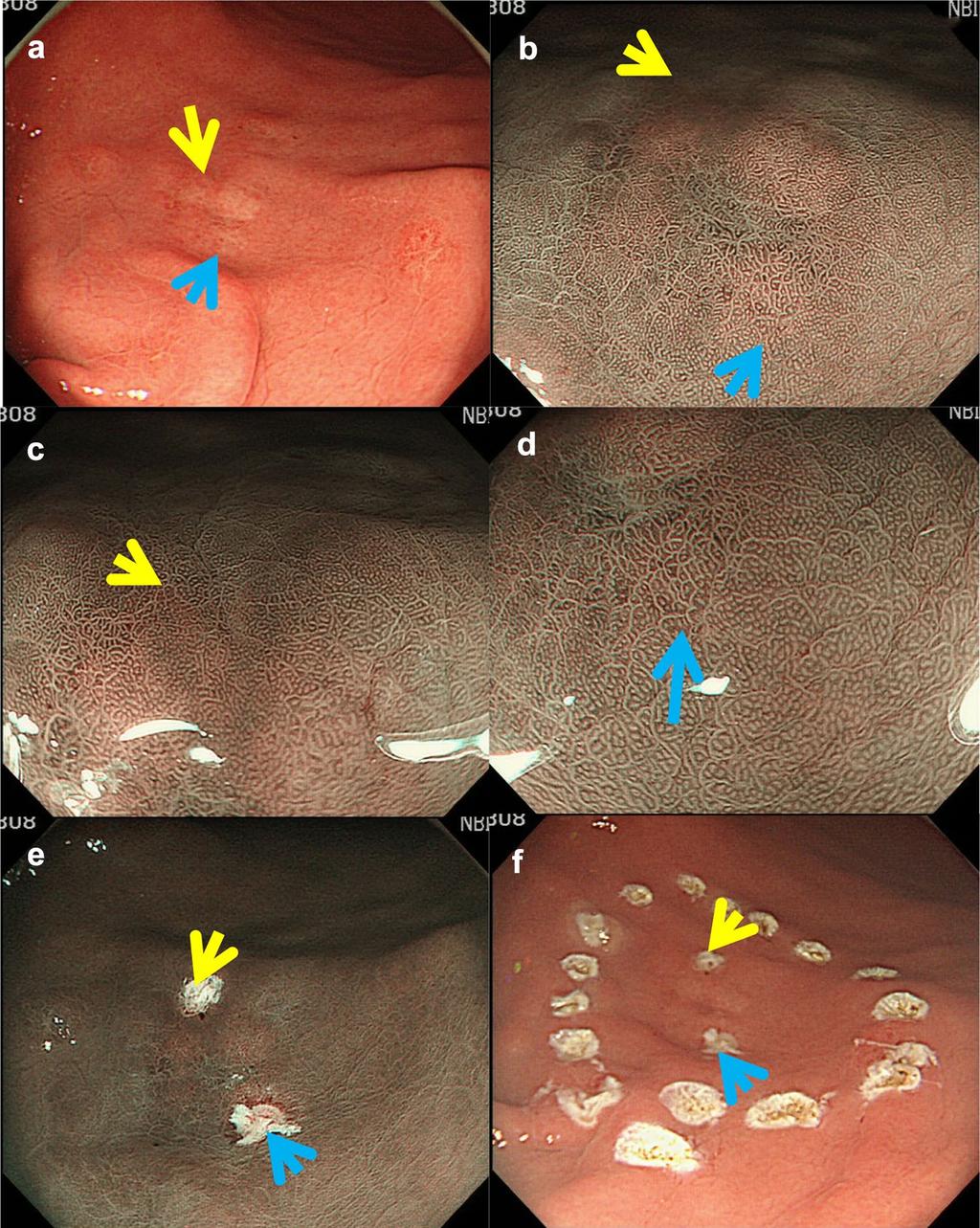 Diagnostic accuracy of demarcation using magnifying endoscopy with narrow-band imaging for 991 Fig. 3 Results of argon plasma coagulation marking. a Whole lesion depicted by white light imaging.