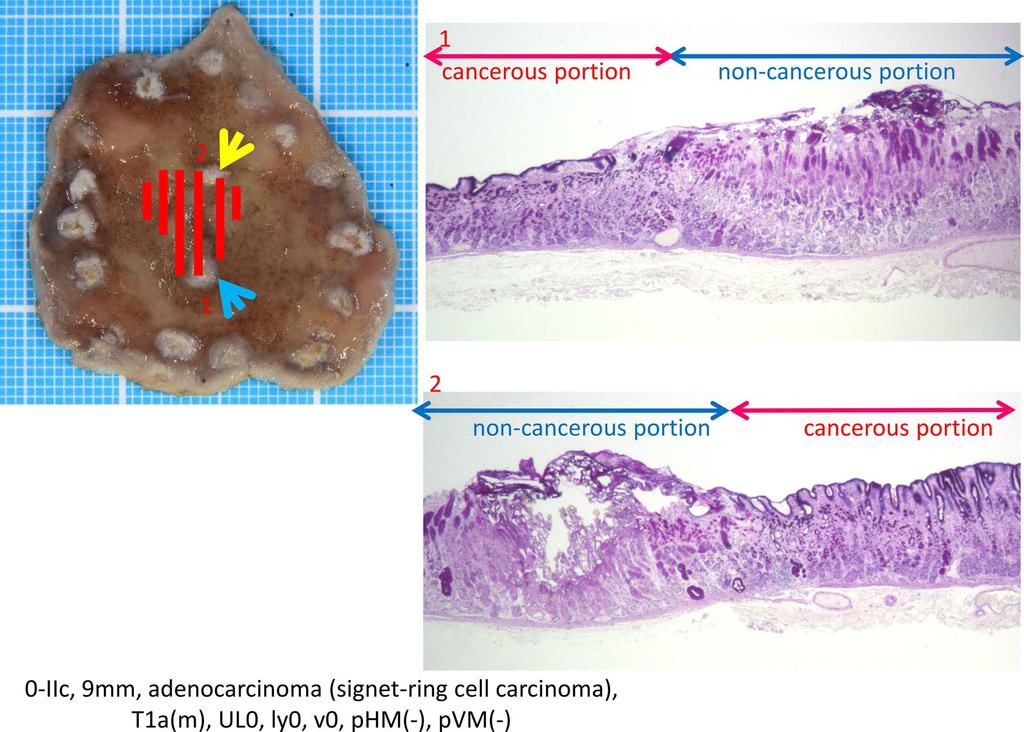 992 Y. Horiuchi et al. Fig. 4 Histopathological specimen after endoscopic submucosal dissection in case shown in Fig. 3.