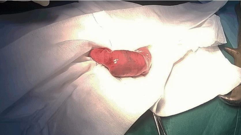 Figure 2: Jejunal obstruction caused by an ectopic gallstone. Figure 3: Enterotomy performed proximal to the obstruction, with removal of the gallstone, measuring 2.5 cm.