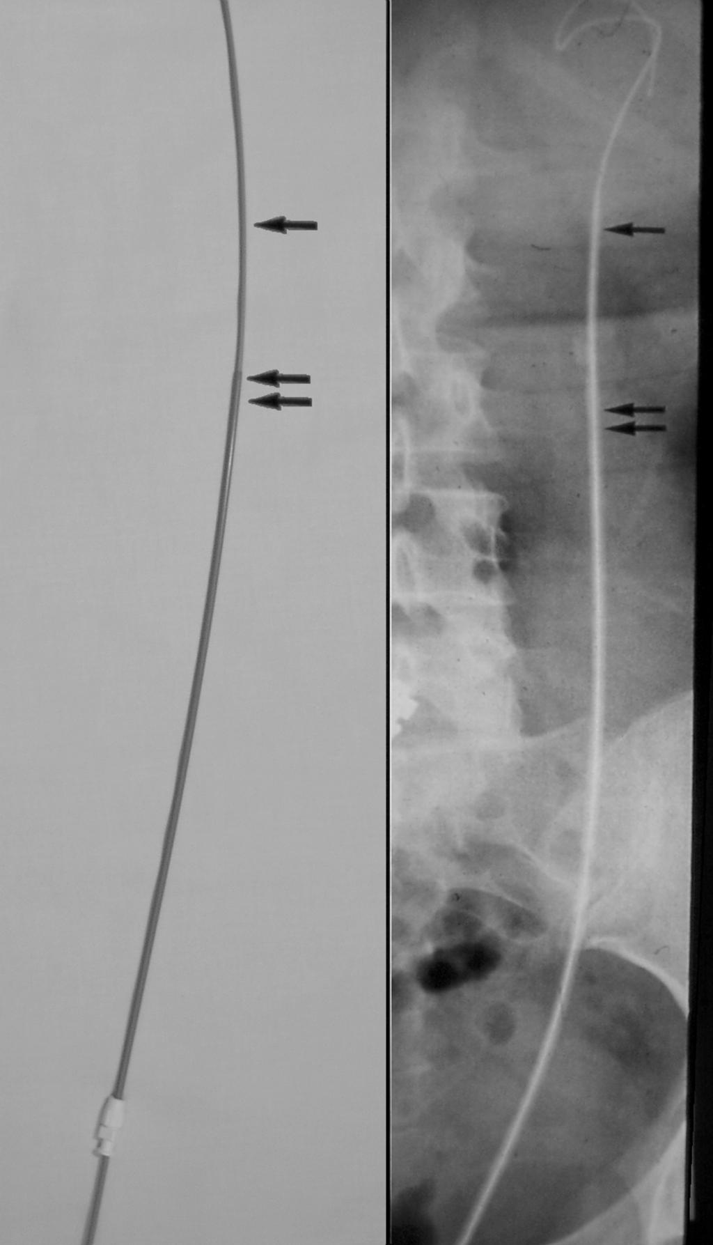 Chapter 2 / Access, Stents, and Urinary Drainage 29 Fig. 3. Table-top and corresponding radiograph of the 8/10 coaxial dilator set.