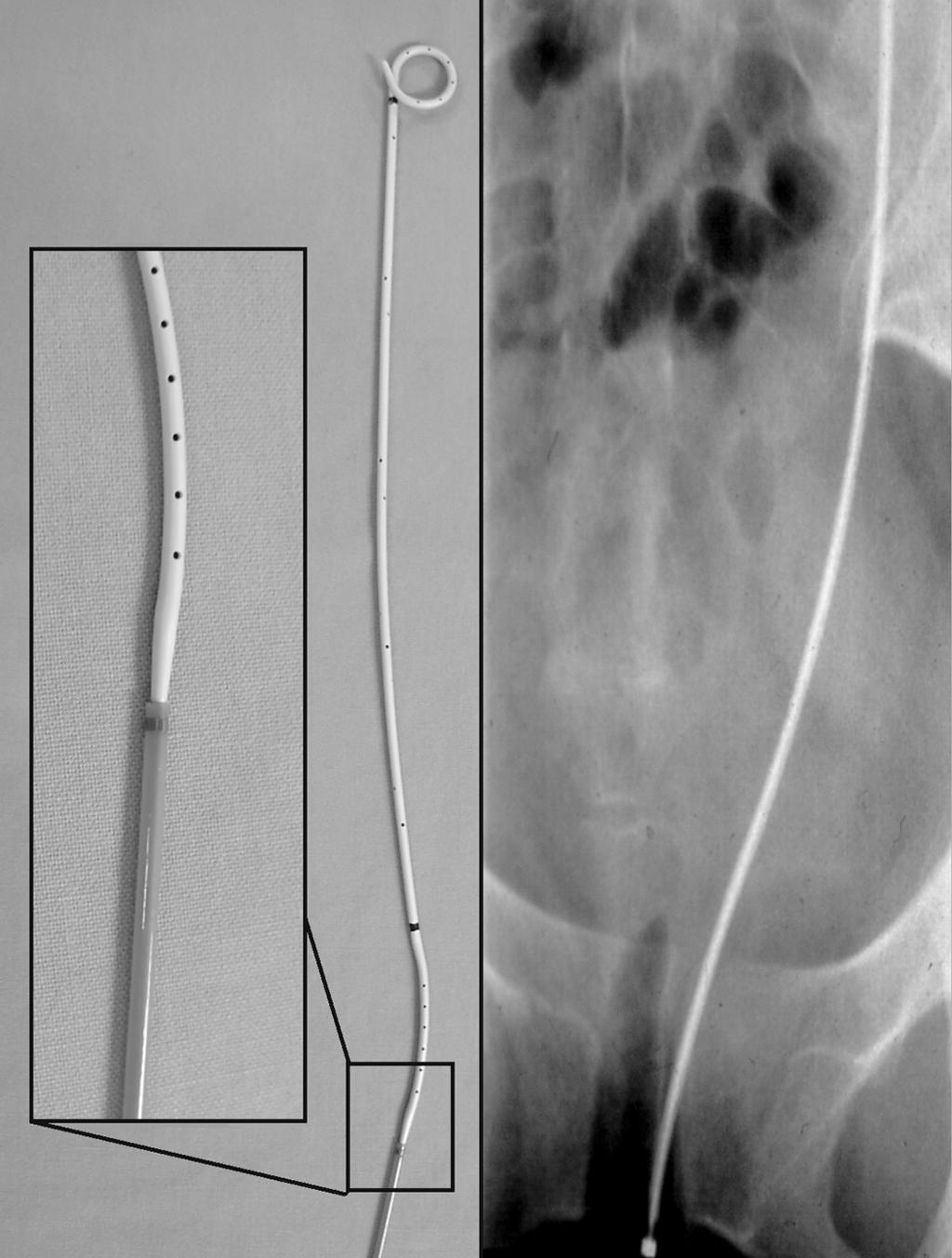 34 Chew and Denstedt Fig. 8. Radiographically, the metal-tipped pusher is at the correct level of the symphysis for a female patient and the 10-Fr sheath has been withdrawn.