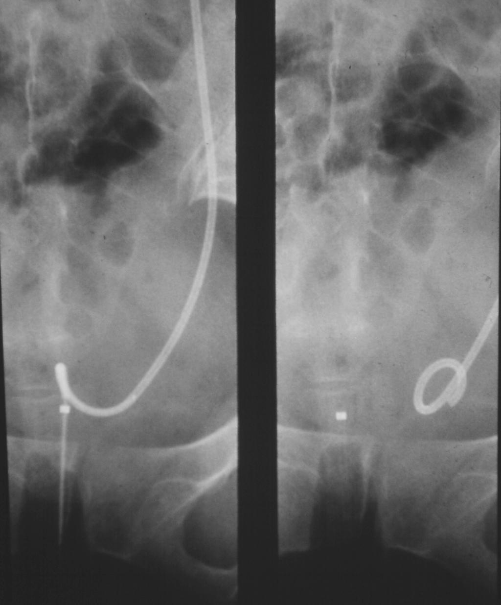 Chapter 2 / Access, Stents, and Urinary Drainage 37 Fig. 11. Radiographic appearance as the guidewire is withdrawn and the stent curls in the bladder.