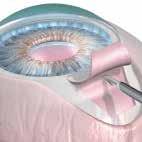 ABiC (Ab interno Canaloplasty) Unlike other glaucoma treatments that bypass the eye s natural drainage channel, or act to mechanically change it, ABiC restores the eyes s natural outflow pathways and