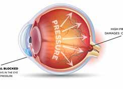 Over time, this increase in pressure may cause damage to some of the sensitive structures that receive and transmit images in the eye, including the optic nerve.