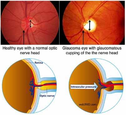 Here are the signs of an acute angle-closure glaucoma attack: Your vision is suddenly blurry You have severe eye pain You have a headache You feel sick to your stomach (nausea) You throw up (vomit)