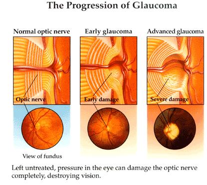 The range for normal pressure is 12-22 mm Hg ( mm Hg refers to millimeters of mercury, a scale used to record eye pressure). Most glaucoma cases are diagnosed with pressure exceeding 20mm Hg.