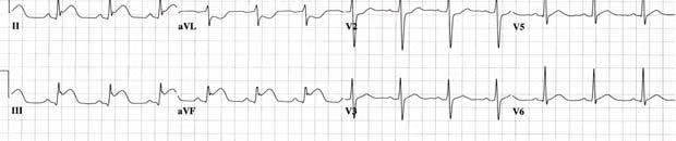 !!...... IN EVERY CASE of INFERIOR WALL STEMI You must first RULE OUT RIGHT VENTRICULAR MI BEFORE giving any: - NITROGLYCERIN -
