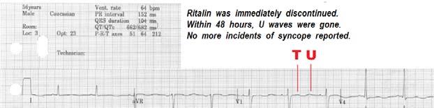 When ECG Indicators of Long QT Synrome are present: Obtain a thorough patient history, to rule out