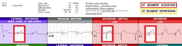 avl in cases of ANTERIOR WALL STEMI, it is a