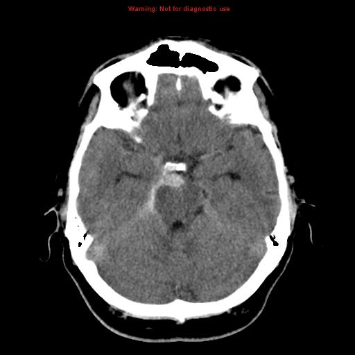 of aneurysmal History CT head Positive