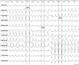 Ital Heart J Vol 6 March 2005 A B Figure 1. Apical infarction. Polymorphic ventricular tachycardia (transition from ventricular tachycardia 1 to 2 and 3) (panel A).