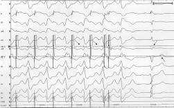 P Della Bella et al - Ventricular tachycardia ablation A B