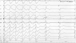 Panel A: induction of VT by pacing from the entrance site