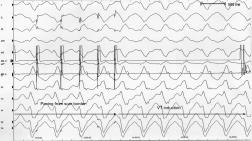 late and fragmented electrograms during sinus rhythm
