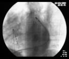 Ablation of epicardial ventricular tachycardia
