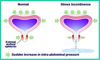 Stress Incontinence Inadequate closing pressure